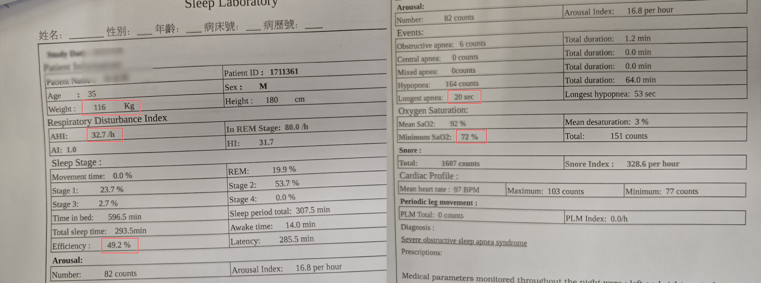 18萬扁桃腺切除心得，亞東醫院一次開4刀全紀錄! - 費用, 保險, 鼻中膈彎曲, 扁桃腺割除, 懸壅垂整形術, 懸壅垂, 利嘉修爾組織凝集器, 鼻中隔, 腺樣體, 懸雍垂 - 敗家達人推薦
