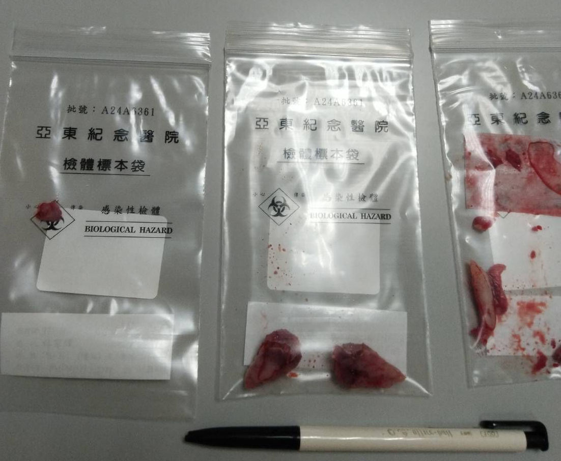 18萬扁桃腺切除心得，亞東醫院一次開4刀全紀錄! - 費用, 保險, 鼻中膈彎曲, 扁桃腺割除, 懸壅垂整形術, 懸壅垂, 利嘉修爾組織凝集器, 鼻中隔, 腺樣體, 懸雍垂 - 敗家達人推薦
